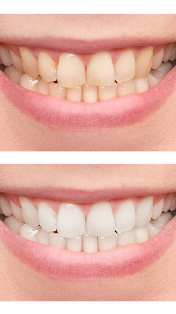 Teeth whitening service in Thiruvalla & Kakkanad