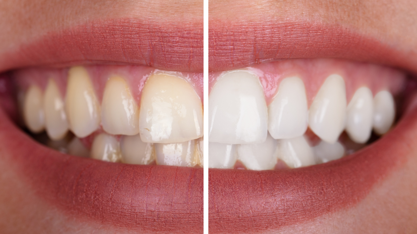 teeth whitening service in Thiruvalla & Kakkanad
