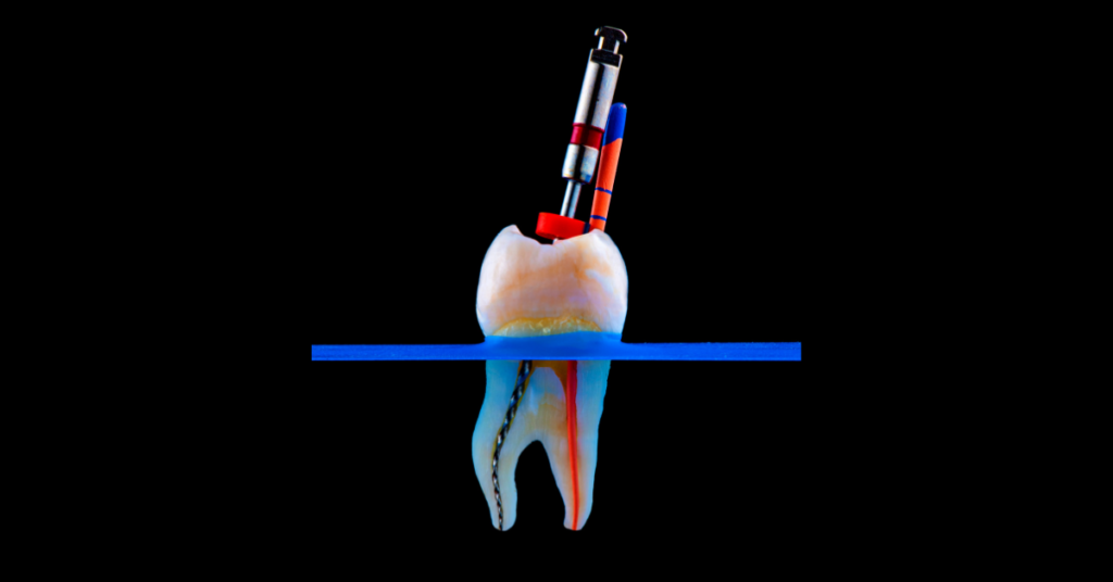 "What Is Same-Day/ Single Visit Root Canal Treatment? Benefits, Procedure & Recovery "