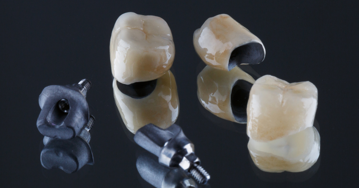 Signs You Might Need a Dental Crown: Beyond the Crack