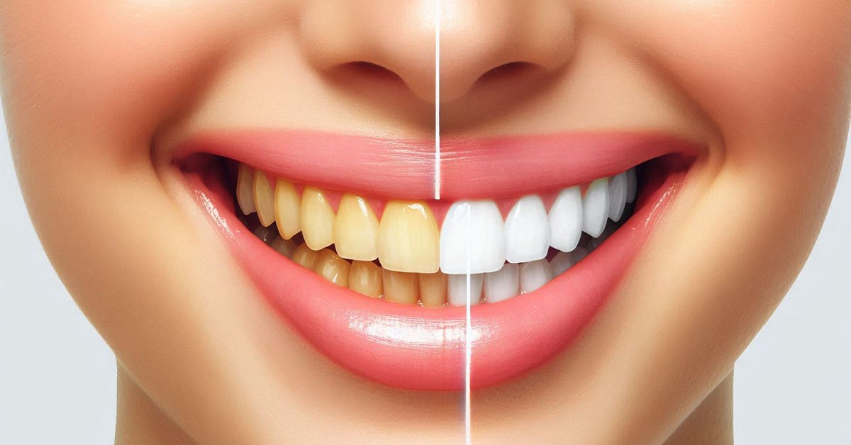 Teeth Whitening Safe? Myths vs. Facts