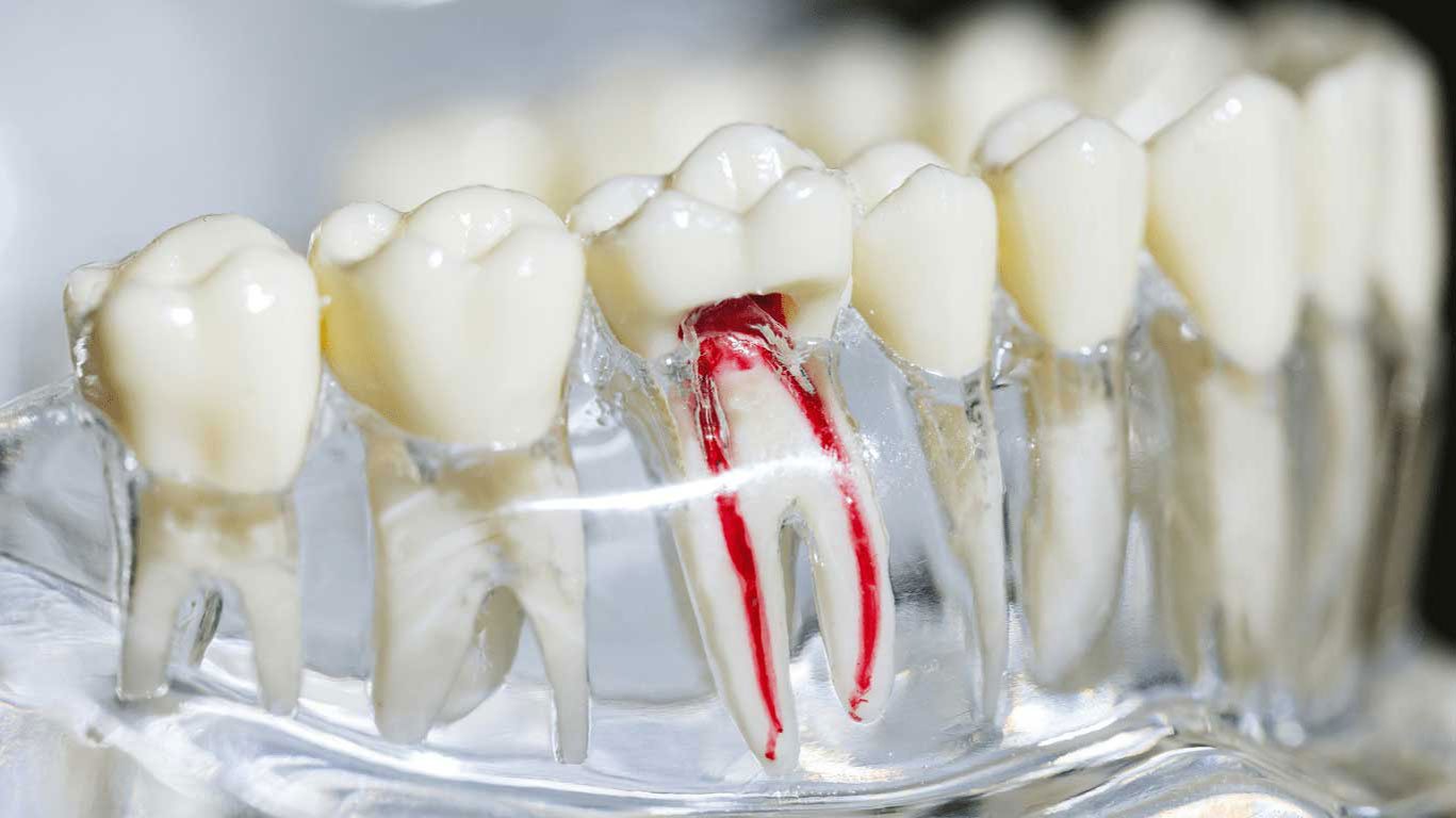 Best root canal treatment in kakkanad