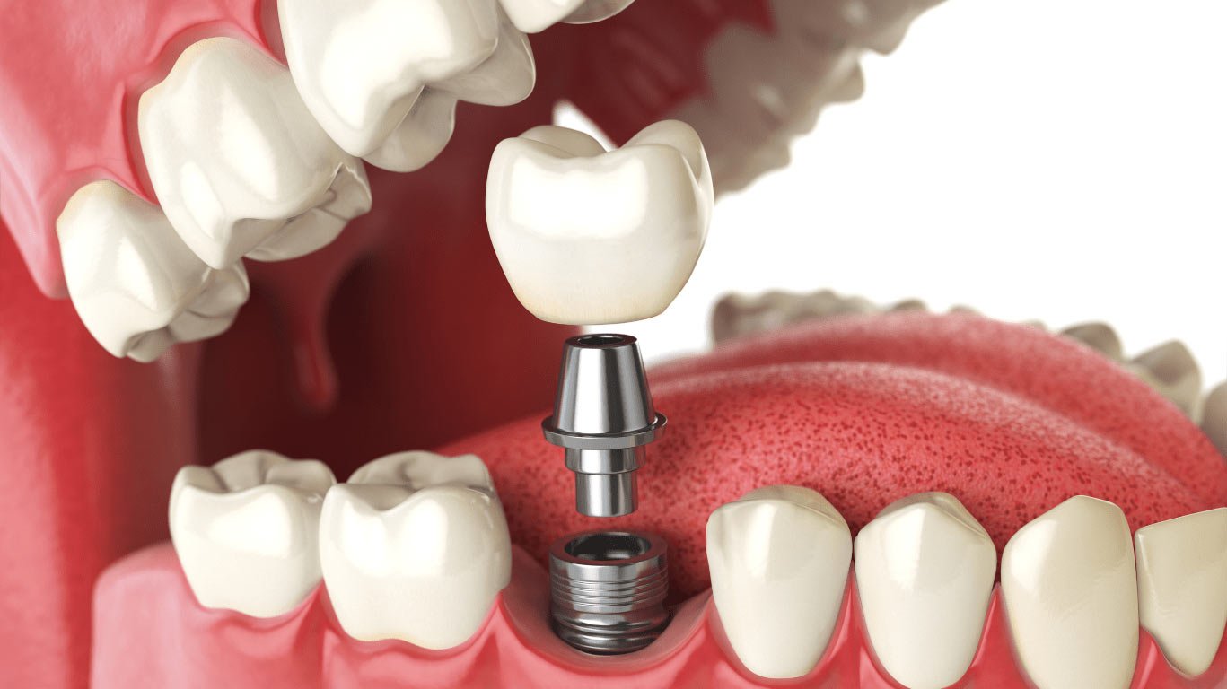Dental implants in Thiruvalla & Kakkanad
