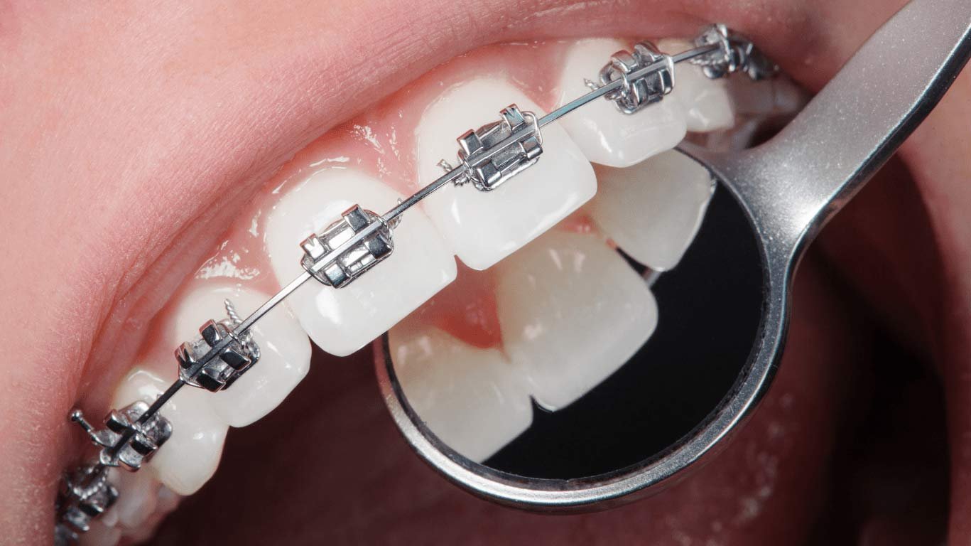 Orthodontics treatment in Thiruvalla & Kakkanad