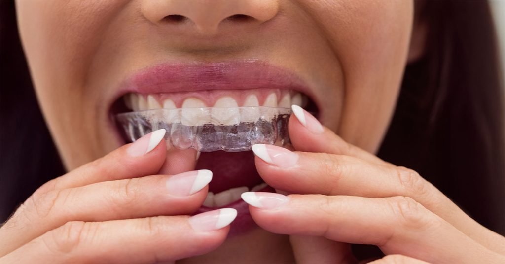 "Why Adults Are Choosing Clear Aligners Over Metal Braces? "