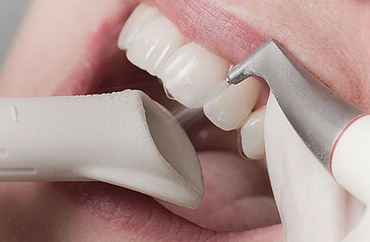 Professional Dental Checkups and Cleaning: What Patients Should Know