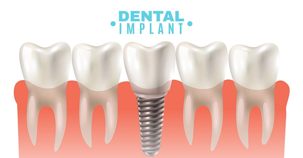 How Long Do Dental Implants Last? Tips for Long-Term Success