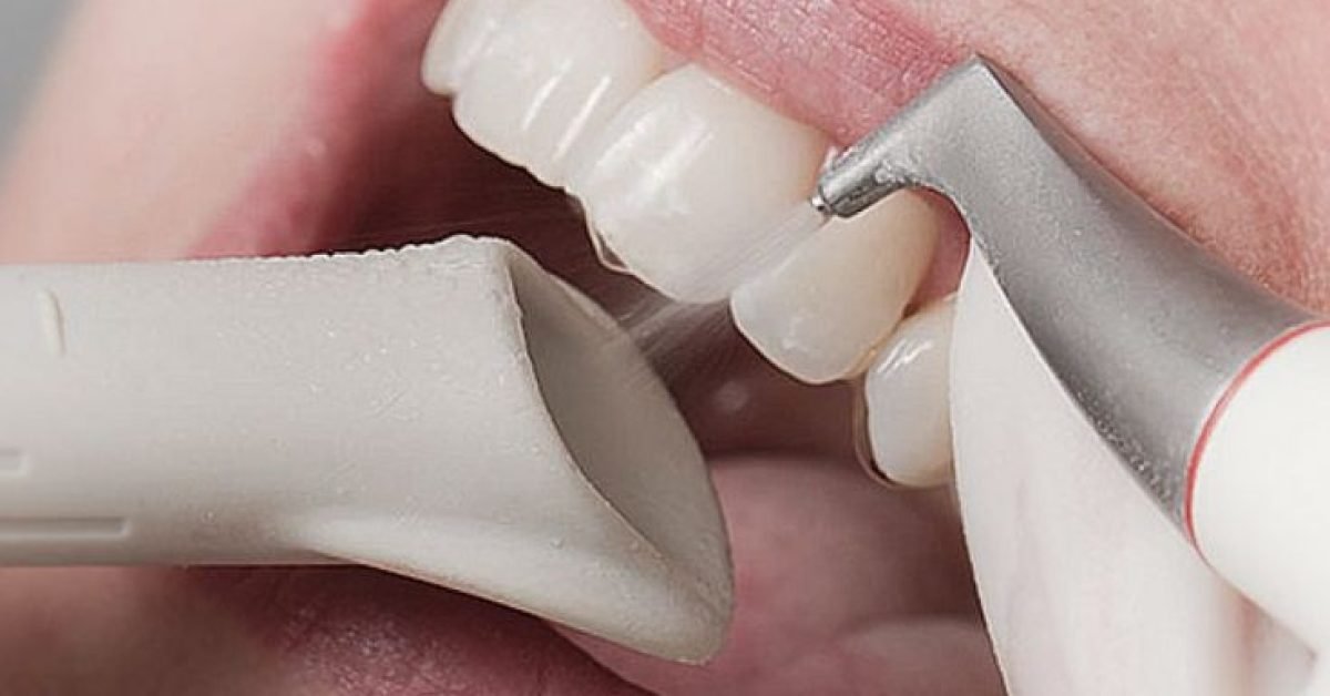 Professional Dental Checkups and Cleaning: What Patients Should Know
